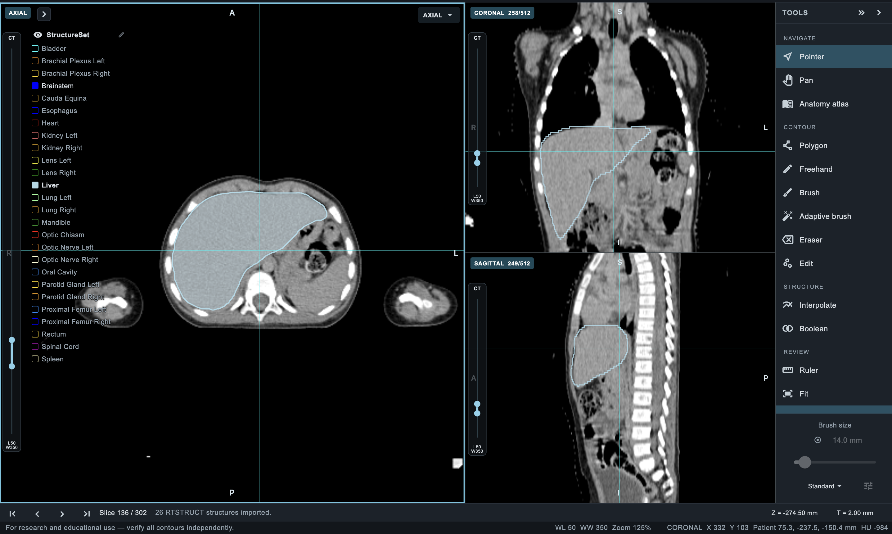 ROContour Workstation showing axial, coronal and sagittal image views with contouring tools